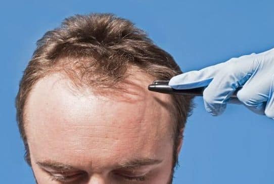 Irritating life-style ‘a significant component for hair loss in males’: Comply with these tricks to handle your stress